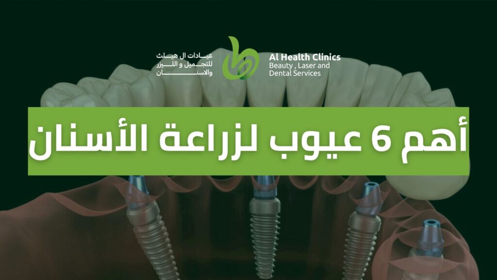 عيوب زراعة الأسنان