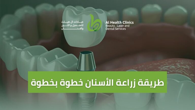 طريقة زراعة الأسنان خطوة بخطوة