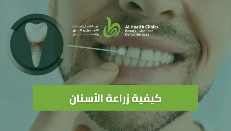 كيفية زراعة الأسنان