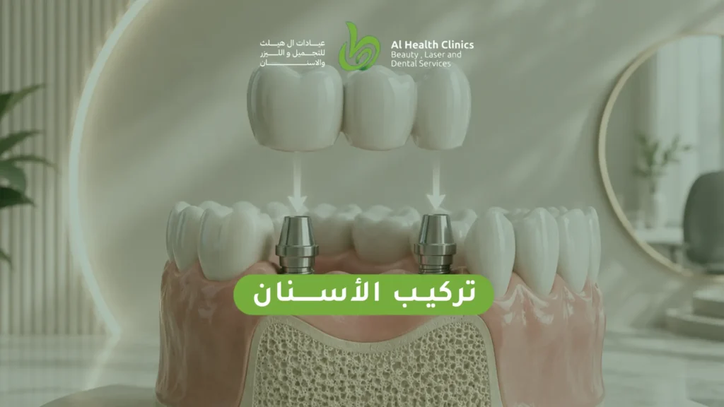 تركيب الأسنان