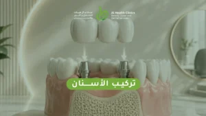 تركيب الأسنان