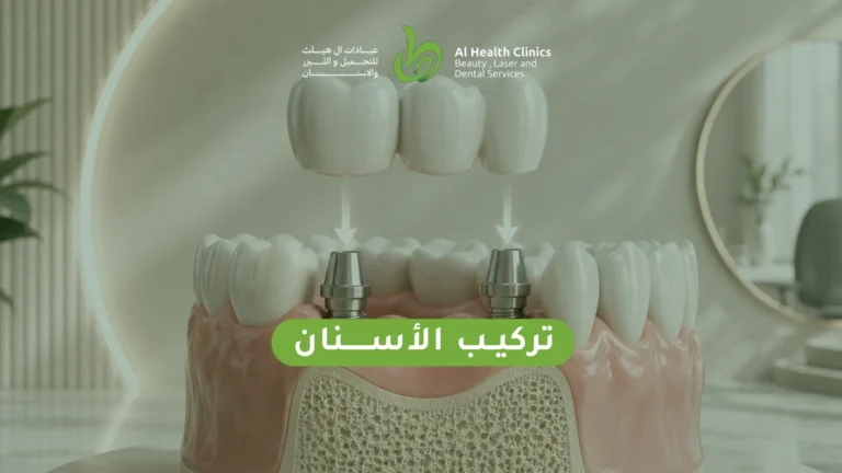 تركيب الأسنان