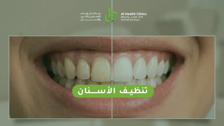 تنظيف الأسنان