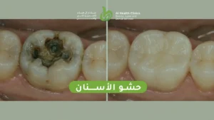 حشو الأسنان