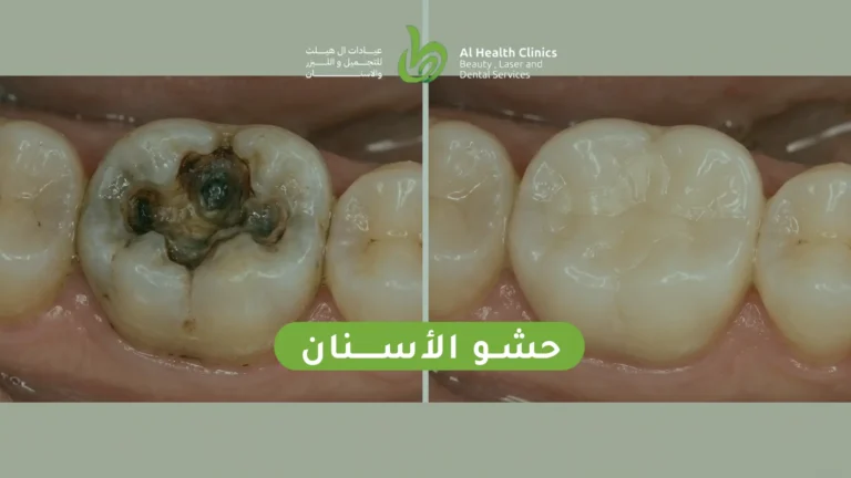 حشو الأسنان