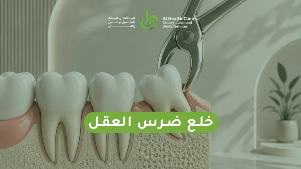 خلع ضرس العقل