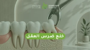 خلع ضرس العقل
