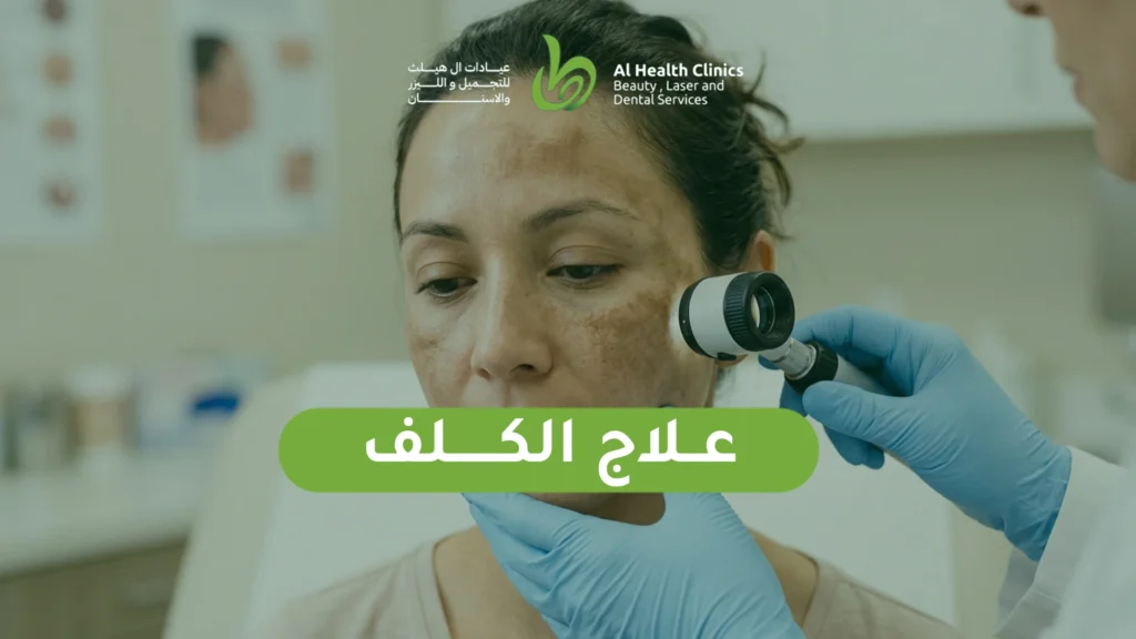 علاج الكلف