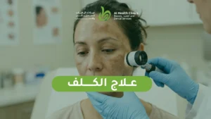 علاج الكلف